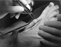 The Institute took a strategic decision to move beyond the hand in the mid- to late-1980s. Used with the permission of the Bernard OBrien Institute of Microsurgery.